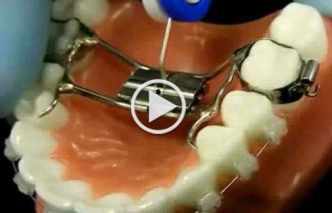 Palatal-Expander-Video-Cover-Image
